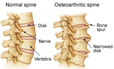 The Link Between Tight Joints and Spinal Arthritis