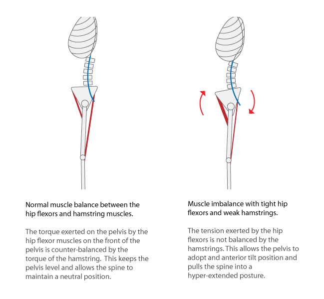 hip-flexor-hamstring-imbalance