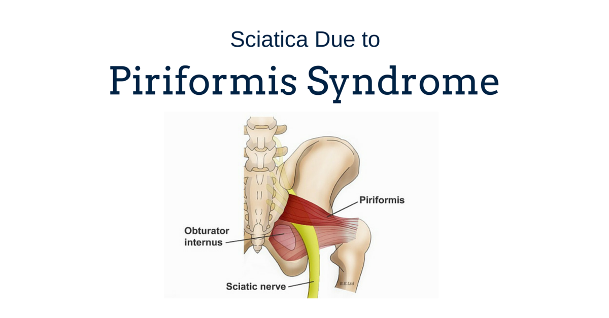 Sciatica Due to Piriformis Syndrome