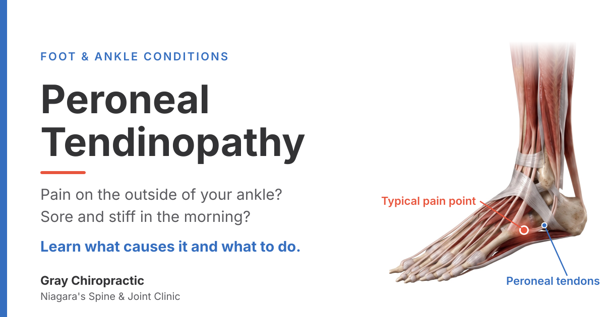 Peroneal tendinopathy: outer ankle and foot pain