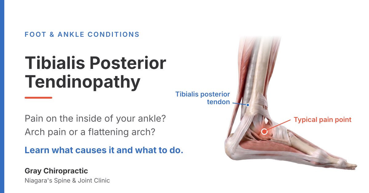 Tibialis posterior tendinopathy: inner ankle and arch pain