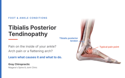 Inner Ankle and Arch Pain: Understanding Tibialis Posterior Tendinopathy